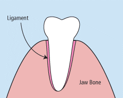 Diagram of tooth needing a dental extraction